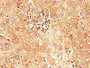 Immunohistochemistry of paraffin-embedded human liver cancer using CAC09639 at dilution of 1:100