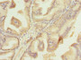 Immunohistochemistry of paraffin-embedded human prostate cancer using CAC09643 at dilution of 1:100