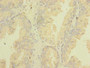 Immunohistochemistry of paraffin-embedded human prostate cancer using CAC09725 at dilution of 1:100