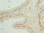Immunohistochemistry of paraffin-embedded human prostate cancer using CAC09746 at dilution of 1:100