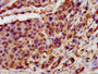 IHC image diluted at 1:400 and staining in paraffin-embedded human pancreatic cancer performed on a Leica BondTM system. After dewaxing and hydration, antigen retrieval was mediated by high pressure in a citrate buffer (pH 6.0). Section was blocked with 10% normal goat serum 30min at RT. Then primary antibody (1% BSA) was incubated at 4°C overnight. The primary is detected by a biotinylated secondary antibody and visualized using an HRP conjugated SP system.