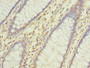 Immunohistochemistry of paraffin-embedded human colon cancer using CAC09794 at dilution of 1:100