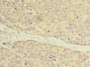 Immunohistochemistry of paraffin-embedded human gastric cancer using CAC09806 at dilution of 1: 100