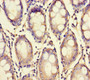 Immunohistochemistry of paraffin-embedded human colon cancer using CAC09821 at dilution of 1:100