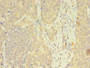 Immunohistochemistry of paraffin-embedded human gastric cancer using CAC09831 at dilution of 1:100