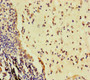 Immunohistochemistry of paraffin-embedded human lung cancer using CAC09903 at dilution of 1:100