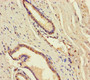 Immunohistochemistry of paraffin-embedded human prostate cancer using CAC09916 at dilution of 1:100