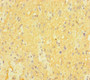 Immunohistochemistry of paraffin-embedded human glioma using CAC09960 at dilution of 1:100