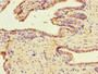 Immunohistochemistry of paraffin-embedded human prostate cancer using CAC09995 at dilution of 1:100