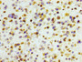 IHC image diluted at 1:100 and staining in paraffin-embedded human glioma cancer performed on a Leica BondTM system. After dewaxing and hydration, antigen retrieval was mediated by high pressure in a citrate buffer (pH 6.0). Section was blocked with 10% normal goat serum 30min at RT. Then primary antibody (1% BSA) was incubated at 4? overnight. The primary is detected by a biotinylated secondary antibody and visualized using an HRP conjugated SP system.