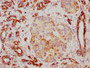 IHC image diluted at 1:117 and staining in paraffin-embedded human pancreatic cancer performed on a Leica BondTM system. After dewaxing and hydration, antigen retrieval was mediated by high pressure in a citrate buffer (pH 6.0). Section was blocked with 10% normal goat serum 30min at RT. Then primary antibody (1% BSA) was incubated at 4? overnight. The primary is detected by a biotinylated secondary antibody and visualized using an HRP conjugated SP system.