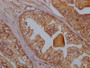 IHC image diluted at 1:100 and staining in paraffin-embedded human prostate cancer performed on a Leica BondTM system. After dewaxing and hydration, antigen retrieval was mediated by high pressure in a citrate buffer (pH 6.0). Section was blocked with 10% normal goat serum 30min at RT. Then primary antibody (1% BSA) was incubated at 4? overnight. The primary is detected by a Goat anti-rabbit IgG polymer labeled by HRP and visualized using 0.05% DAB.