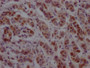 IHC image diluted at 1:100 and staining in paraffin-embedded human breast cancer performed on a Leica BondTM system. After dewaxing and hydration, antigen retrieval was mediated by high pressure in a citrate buffer (pH 6.0). Section was blocked with 10% normal goat serum 30min at RT. Then primary antibody (1% BSA) was incubated at 4? overnight. The primary is detected by a Goat anti-rabbit IgG polymer labeled by HRP and visualized using 0.05% DAB.