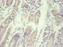Immunohistochemical of paraffin-embedded human gastric cancer tissue using CAC10258 at dilution of 1:200.
