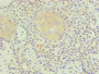 Immunohistochemical of paraffin-embedded human breast cancer using CAC10259 at dilution of 1:200.