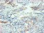 Immunohistochemical of paraffin-embedded human breast cancer tissue using CAC10262 at dilution of 1:200