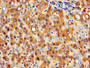 IHC image diluted at 1:300 and staining in paraffin-embedded human liver cancer performed on a Leica BondTM system. After dewaxing and hydration, antigen retrieval was mediated by high pressure in a citrate buffer (pH 6.0). Section was blocked with 10% normal goat serum 30min at RT. Then primary antibody (1% BSA) was incubated at 4°C overnight. The primary is detected by a biotinylated secondary antibody and visualized using an HRP conjugated SP system.