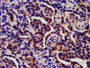 IHC image of CAC10380 diluted at 1:200 and staining in paraffin-embedded human lung cancer performed on a Leica BondTM system. After dewaxing and hydration, antigen retrieval was mediated by high pressure in a citrate buffer (pH 6.0). Section was blocked with 10% normal goat serum 30min at RT. Then primary antibody (1% BSA) was incubated at 4°C overnight. The primary is detected by a biotinylated secondary antibody and visualized using an HRP conjugated SP system.