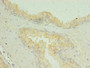 Immunohistochemistry of paraffin-embedded human prostate cancer using CAC10382 at dilution of 1:100
