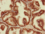 Immunohistochemistry of paraffin-embedded human prostate cancer using CAC10384 at dilution of 1:100