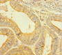 Immunohistochemistry of paraffin-embedded human endometrial cancer using CAC10393 at dilution of 1:100