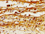 Immunohistochemistry of paraffin-embedded human melanoma using CAC10396 at dilution of 1:100