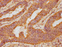 IHC image diluted at 1:90 and staining in paraffin-embedded human colon cancer performed on a Leica BondTM system. After dewaxing and hydration, antigen retrieval was mediated by high pressure in a citrate buffer (pH 6.0). Section was blocked with 10% normal goat serum 30min at RT. Then primary antibody (1% BSA) was incubated at 4°C overnight. The primary is detected by a biotinylated secondary antibody and visualized using an HRP conjugated SP system.