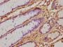 IHC image of CAC10441 diluted at 1:500 and staining in paraffin-embedded human gastric cancer performed on a Leica BondTM system. After dewaxing and hydration, antigen retrieval was mediated by high pressure in a citrate buffer (pH 6.0). Section was blocked with 10% normal goat serum 30min at RT. Then primary antibody (1% BSA) was incubated at 4°C overnight. The primary is detected by a biotinylated secondary antibody and visualized using an HRP conjugated SP system.