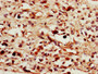 IHC image diluted at 1:1400 and staining in paraffin-embedded human melanoma performed on a Leica BondTM system. After dewaxing and hydration, antigen retrieval was mediated by high pressure in a citrate buffer (pH 6.0). Section was blocked with 10% normal goat serum 30min at RT. Then primary antibody (1% BSA) was incubated at 4°C overnight. The primary is detected by a biotinylated secondary antibody and visualized using an HRP conjugated SP system.
