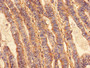 Immunohistochemistry analysis of human colon cancer using CAC10453 at dilution of 1:100