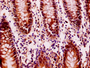 Immunohistochemistry of paraffin-embedded human colon cancer using CAC10454 at dilution of 1:100