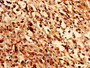 Immunocytochemistry analysis of human melanoma using CAC10456 at dilution of 1:100