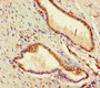 Immunohistochemistry of paraffin-embedded human prostate cancer using CAC10471 at dilution of 1:100