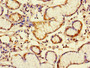 Immunohistochemistry of paraffin-embedded human gastric cancer using CAC10474 at dilution of 1:100