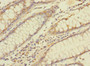 Immunohistochemistry of paraffin-embedded human colon cancer using CAC10475 at dilution of 1:100