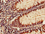 Immunohistochemistry of paraffin-embedded human colon cancer using CAC10483 at dilution of 1:100