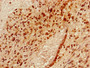 Immunohistochemistry of paraffin-embedded human glioma using CAC10483 at dilution of 1:100