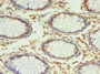 Immunohistochemistry of paraffin-embedded human colon cancer using CAC10498 at dilution of 1:100