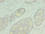 Immunohistochemistry of paraffin-embedded human gastric cancer using CAC10506 at dilution of 1:100