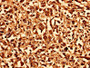 Immunohistochemistry analysis of human melanoma using CAC10510 at dilution of 1:100