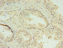 Immunohistochemistry of paraffin-embedded human prostate cancer using CAC10524 at dilution of 1:100
