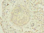 Immunohistochemistry of paraffin-embedded human cervical cancer using CAC10526 at dilution of 1:100