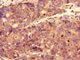 Immunocytochemistry analysis of human gastric cancer using CAC10529 at dilution of 1:100
