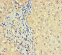 Immunohistochemistry of paraffin-embedded human liver cancer using CAC10538 at dilution of 1:100