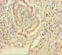 Immunohistochemistry of paraffin-embedded human pancreatic cancer using CAC10541 at dilution of 1:100