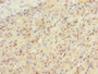 Immunohistochemistry of paraffin-embedded human liver cancer using CAC10544 at dilution of 1:100