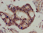 Immunohistochemistry of paraffin-embedded human pancreatic cancer using CAC10548 at dilution of 1:100