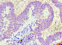 Immunohistochemistry of paraffin-embedded human ovarian cancer using CAC10562 at dilution of 1:100
