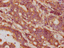 IHC image diluted at 1:132 and staining in paraffin-embedded human colon cancer performed on a Leica BondTM system. After dewaxing and hydration, antigen retrieval was mediated by high pressure in a citrate buffer (pH 6.0). Section was blocked with 10% normal goat serum 30min at RT. Then primary antibody (1% BSA) was incubated at 4°C overnight. The primary is detected by a biotinylated secondary antibody and visualized using an HRP conjugated SP system.