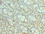 Immunohistochemistry of paraffin-embedded human colon cancer using CAC10569 at dilution of 1:100